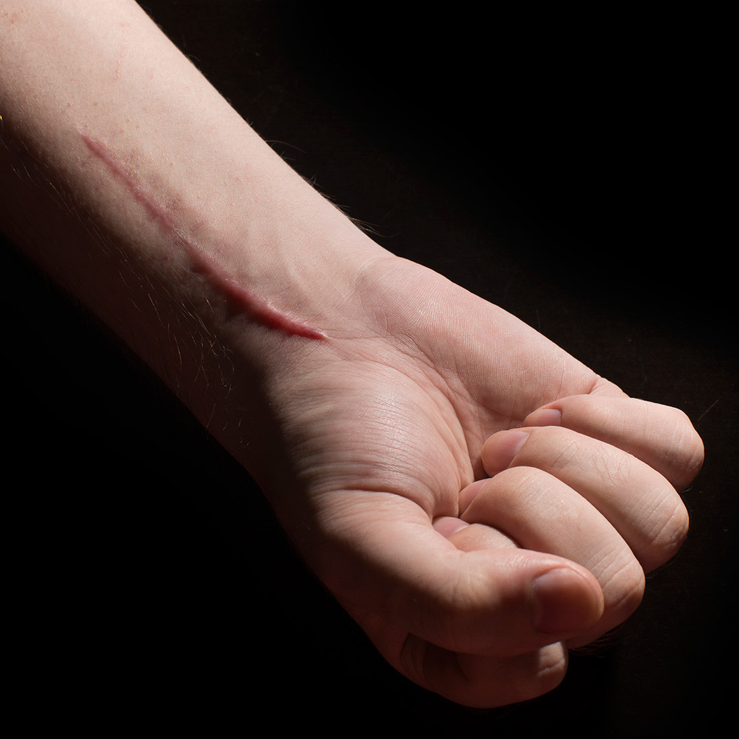 A hand with a raised scar